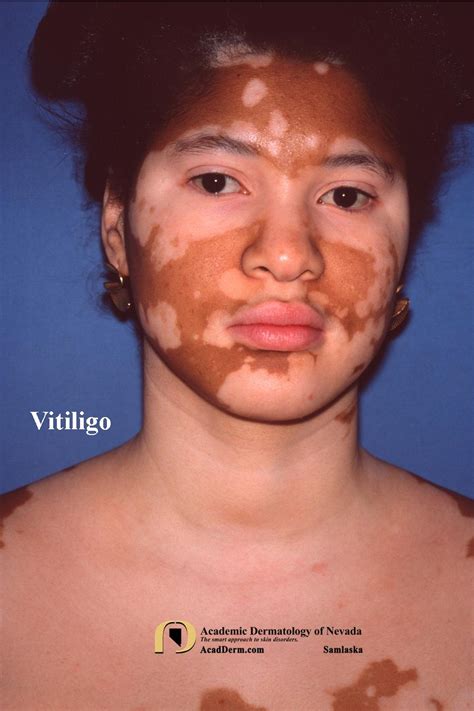 Hva er forskjellen mellom Vitiligo og Leukoderma?